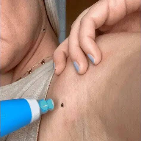 UniTag™ - Kit Professionale Rimozione Fibromi