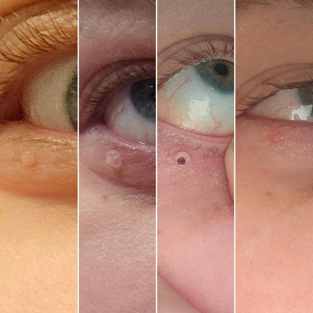 UniTag™ - Kit Professionale Rimozione Fibromi