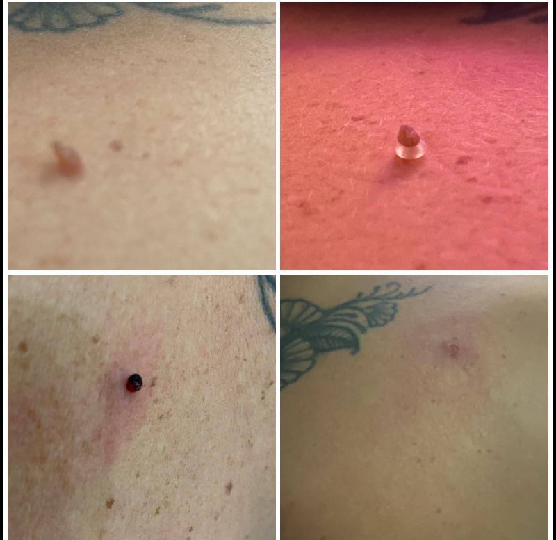 UniTag™ - Kit Professionale Rimozione Fibromi